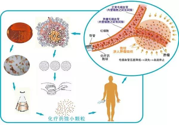 介入治疗癌症的最新方法,血管介入治疗癌症效果怎么样