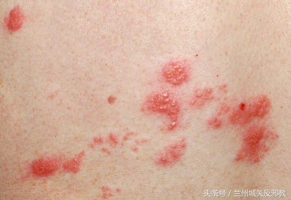 祛湿之前必须先弄明白一件事,祛湿先去寒