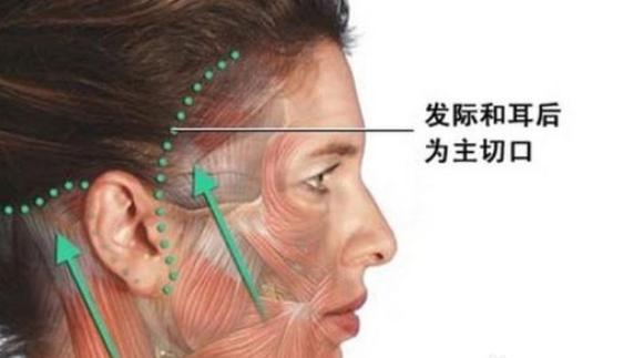 微创除皱手术与大拉皮除皱手术,微创除皱和拉皮的区别