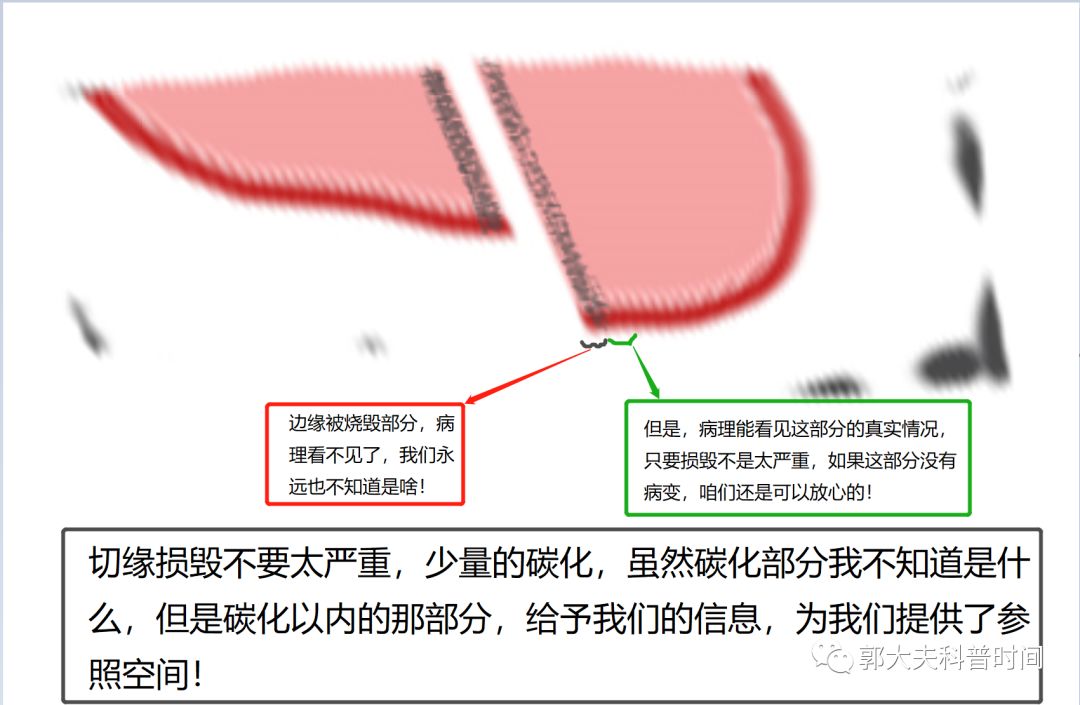 leep手术会导致子宫内膜变薄吗,leep手术为啥没有填塞纱布