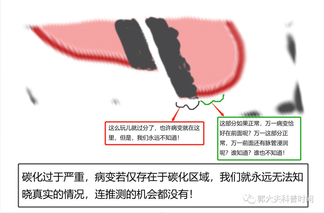 leep手术会导致子宫内膜变薄吗,leep手术为啥没有填塞纱布