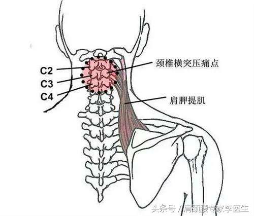李医生颈椎病,李医生颈椎病最好的锻炼方法