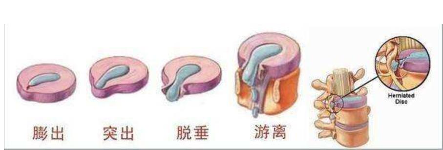 腰椎间盘突出腰腿不痛就是脚无力,腰椎间盘突出腰腿酸软无力中药