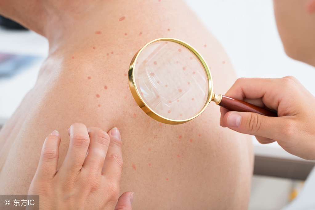 荨麻疹过敏源太强怎么办,荨麻疹湿疹过敏性鼻炎同时出现