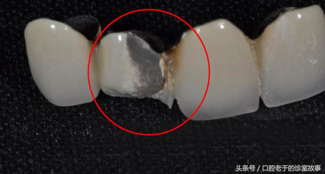 缺一颗牙种植好还是搭桥好,23岁下一排牙缺四颗可以矫正吗