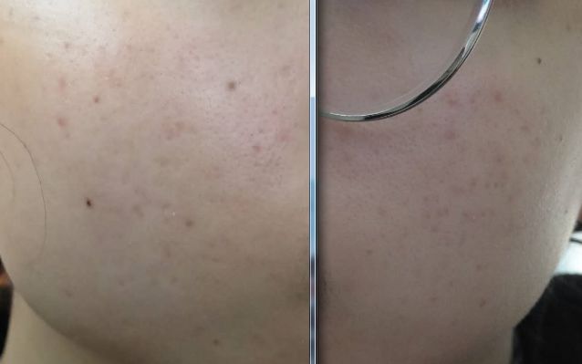 作为一个长痘痘多年的人,分享给痘友抗痘经历