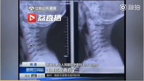 科学9岁儿童颈椎变成一条直线,9岁男孩颈椎变形