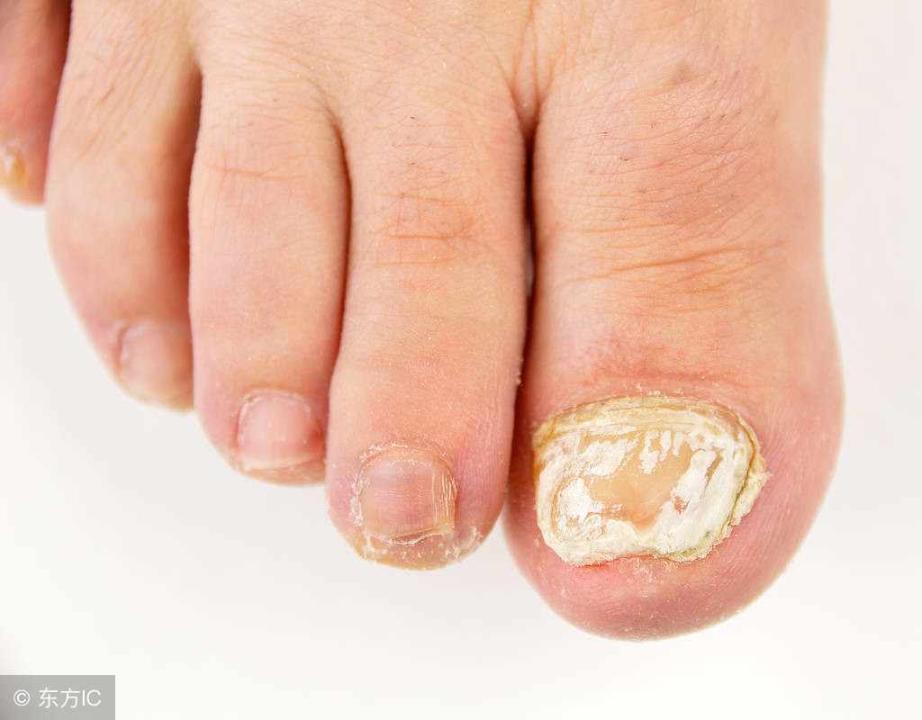 灰指甲引起的真菌感染怎么治疗,灰指甲真菌感染是怎么引起的