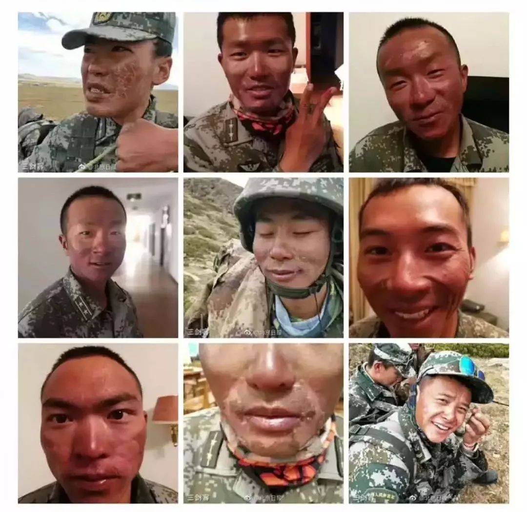 中国驻训高原官兵脸被灼伤,高原地区紫外线灼伤