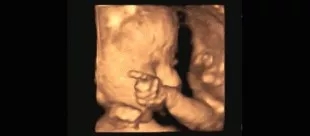 为什么我的彩超看不清宝宝,为什么我的四维彩超看不见脑门