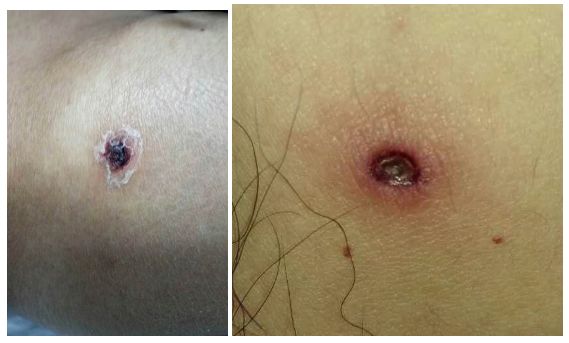 小小虫咬伤，伤害那么大！