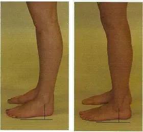 瑜伽拉伸体式练习，纠正膝盖超伸