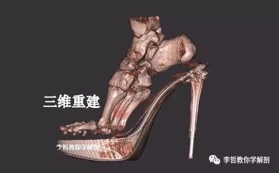 拇外翻该怎么办,拇外翻的解决方法