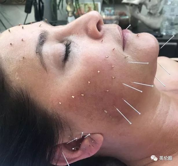 哈里梅根婚前求助中医！歪果仁已经把针灸吹上了天