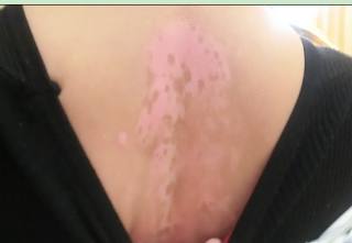 白癜风在治疗中为啥还会发展,治疗白癜风会损伤肾脏吗