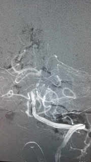 与死神角力！景德镇市一院卒中中心成功挽救一名急性脑梗死患者