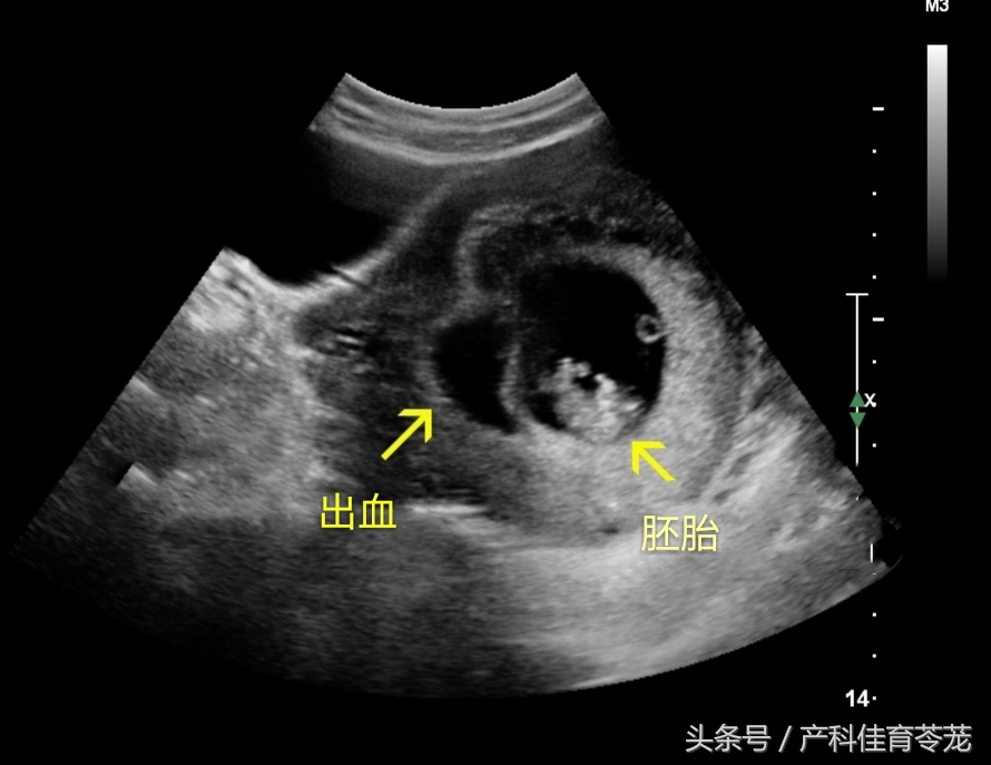 绒毛膜下血肿一定要卧床休息吗,绒毛膜下血肿保胎最佳方法