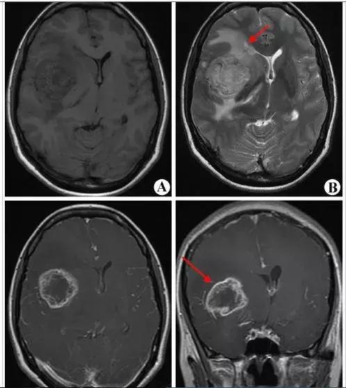 玩手机得脑瘤的几率大吗,玩手机多长时间会得脑瘤