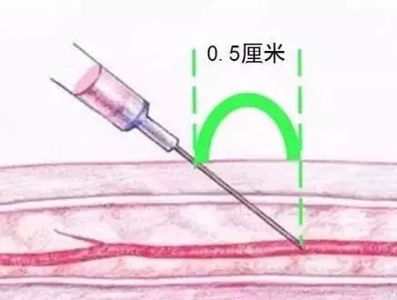 抽血后淤青鼓包疼痛怎么处理,抽血没有按压好淤青严重吗