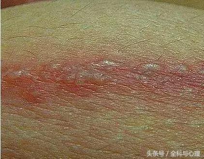 带状疱疹的问诊要点,眼部带状疱疹治疗方法及用药