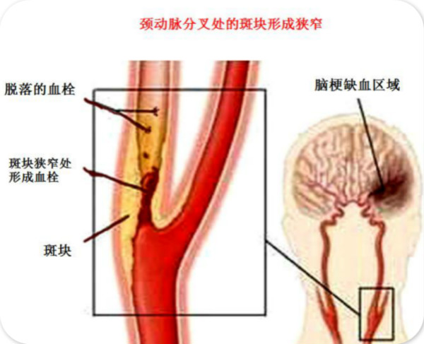 血管斑块咋回事？就像河流淤积的泥沙，有时没事，却怕在险滩出事