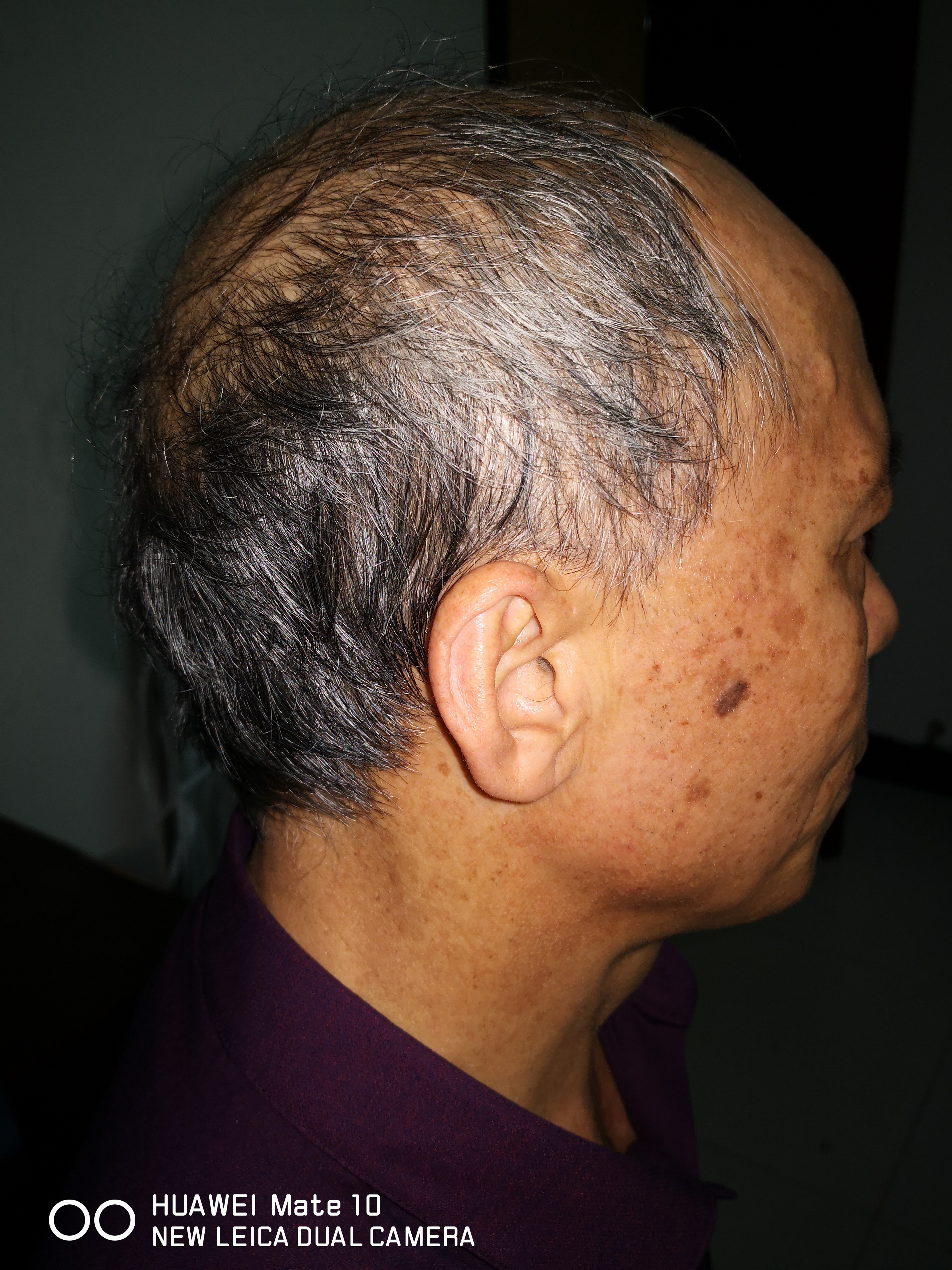 股骨头坏死二期置换好吗,遗传型脱发白发