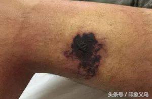 小孩被毒蜘蛛咬伤,小男孩被蜘蛛咬伤了