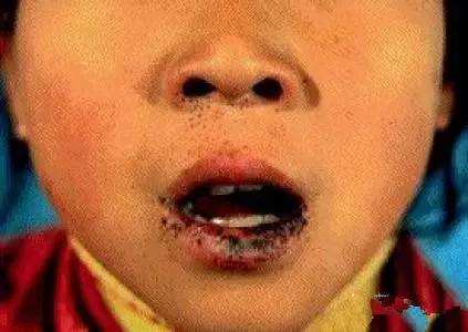 体检发现肠息肉病例,年轻女性查出肠息肉