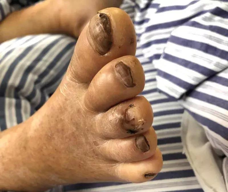 被自行车踏板划伤了要打破伤风吗,破伤风发作进icu一般多久能出来