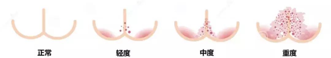 尿布疹护臀膏怎么用,护臀膏能治尿疹吗