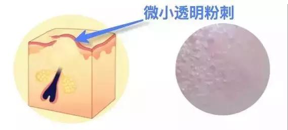 去除闭口有什么最简单的好办法,如何简单有效去闭口