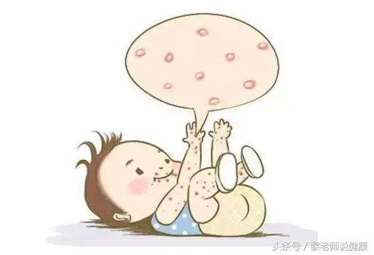 湿疹严重影响你的生活？教你3个湿疹止痒良方！效果不是一般的好