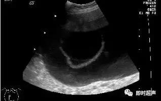卵巢畸胎瘤的超声声像诊断,超声能不能看到卵巢畸胎瘤内部