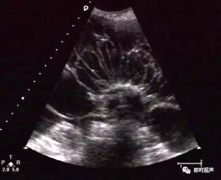 卵巢畸胎瘤的超声声像诊断,超声能不能看到卵巢畸胎瘤内部