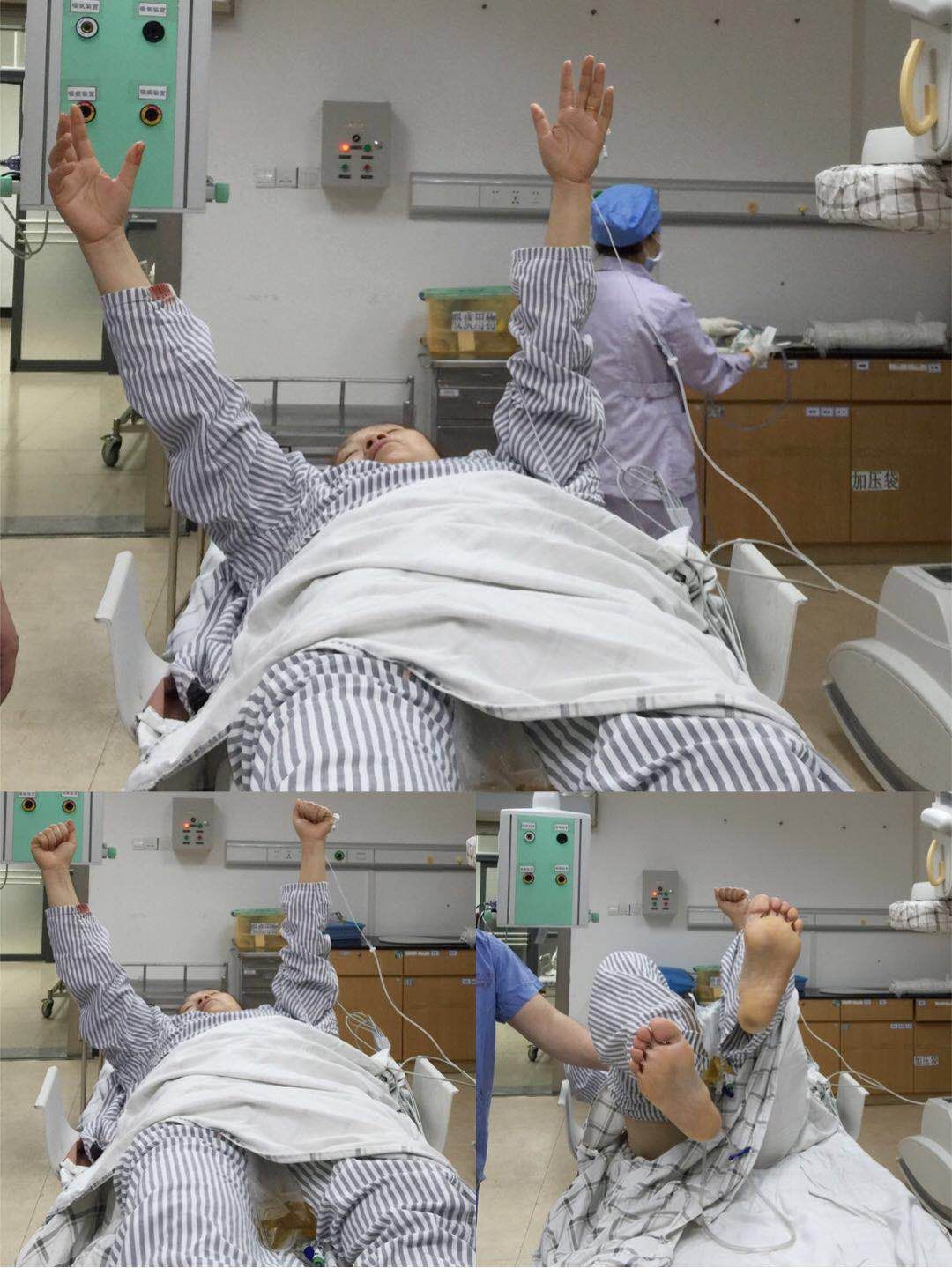 基底动脉闭合手术,基底动脉闭塞取栓一直昏睡