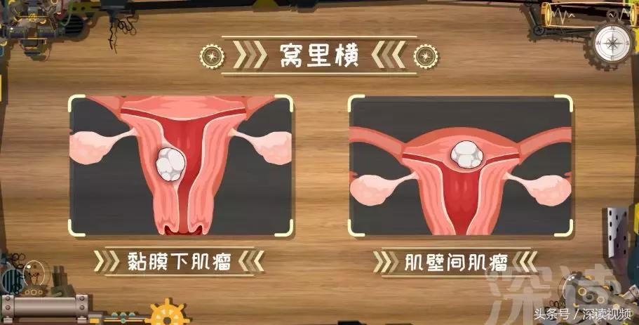 子宫肌瘤在哪个地方影响怀孕,子宫肌瘤剔除怎么还有东西流出来