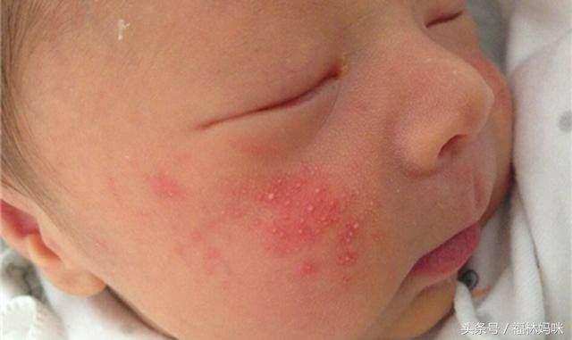 宝宝湿疹和痱子怎么区别,宝宝得了湿疹痱子解决方法
