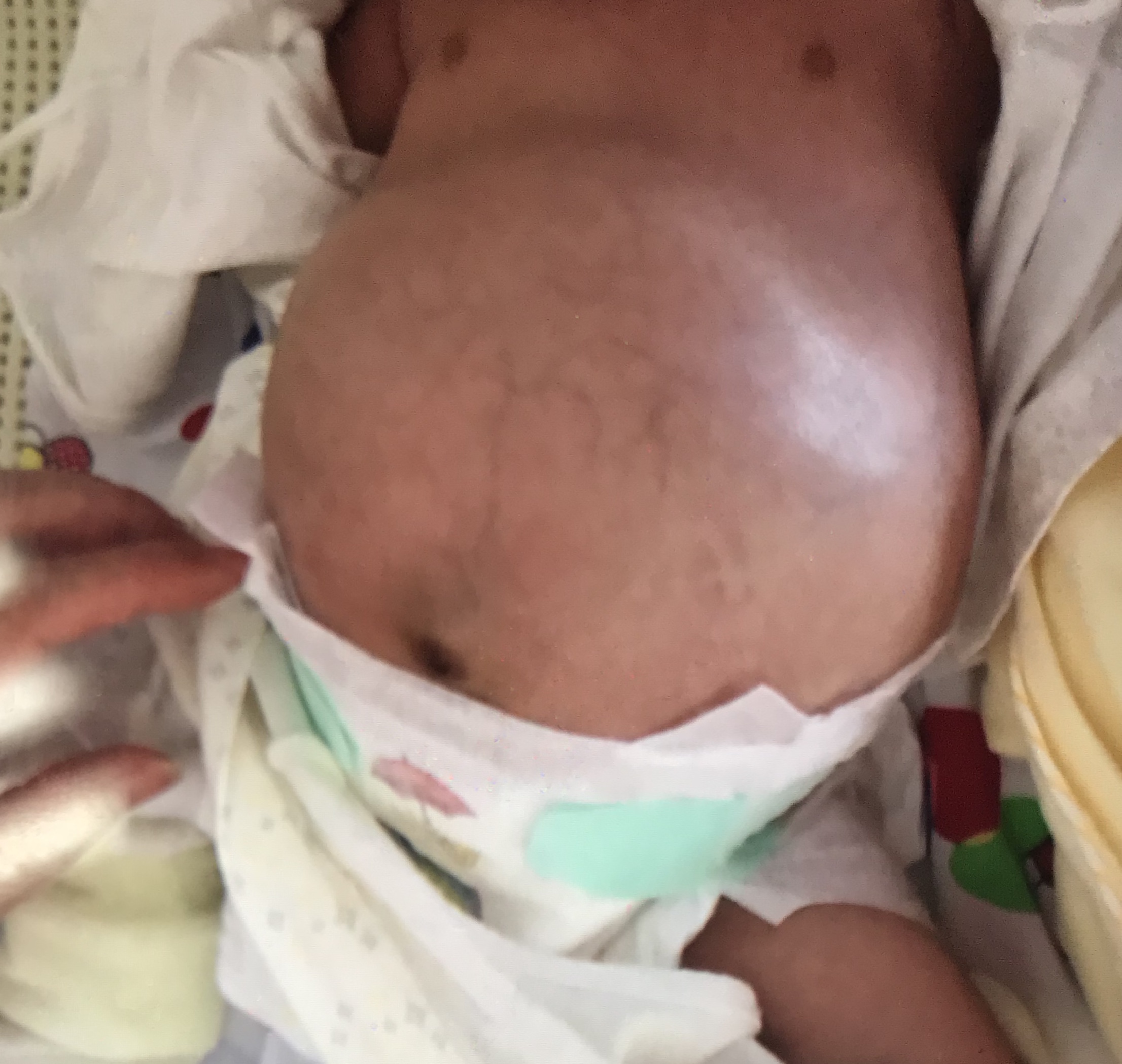 宝宝腹胀如鼓,儿童结肠胀气的症状及治疗