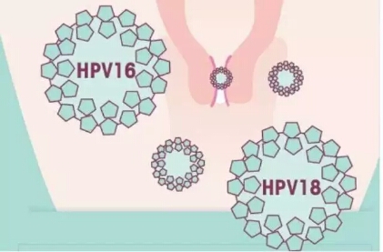 hpv51和52都是阳性如何处理,hpv阳性为什么医生怀疑艾滋病