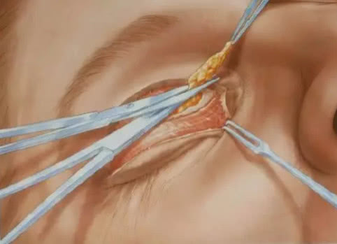 双眼皮是怎么做的？你知道吗？