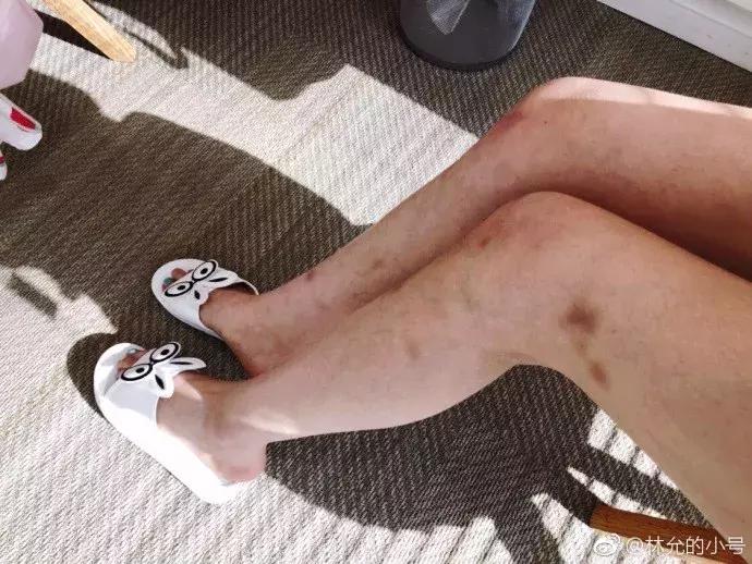 林允暴瘦照片,林允腿上的淤青原因