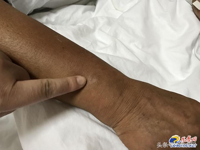 蜱虫重灾区是哪,南京鼓楼医院蜱虫