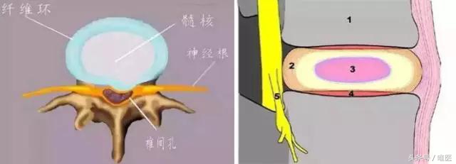 马塞洛腰伤怪俄罗斯的床？3个动作1套操，骨科医生教您缓解腰疼