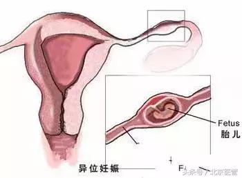 与时间赛跑成功抢救心梗患者,宫外孕大出血死里逃生捡回一命