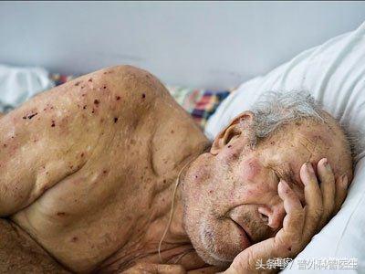 癌症晚期无法进食全身浮水,癌症晚期无法排便怎么回事