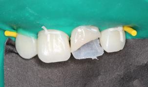 怎么拯救牙齿最快最有效,如何拯救牙齿