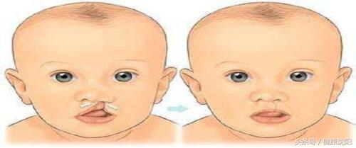 拔牙注意事项科普演讲,聊聊拔牙的那些事儿术后饮食篇