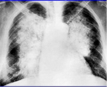 肺水肿和左心衰如何鉴别诊断,蝶翼征