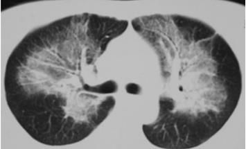 肺水肿和左心衰如何鉴别诊断,蝶翼征