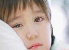 孩子得了结膜炎的图片,得了过敏性结膜炎该注意什么
